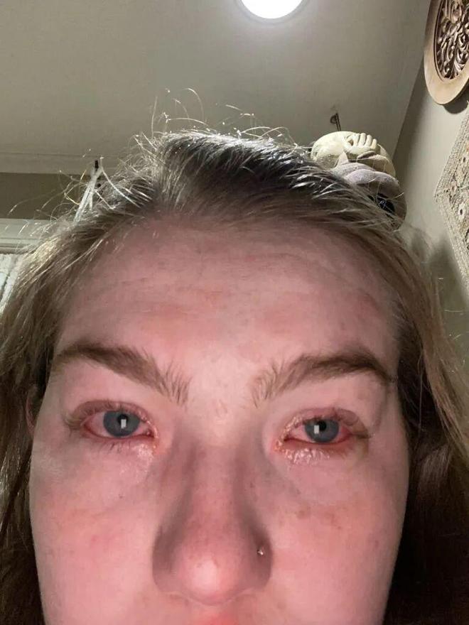 J9数字站笑哭！女子满脸爆痘眼睛长满皮疹